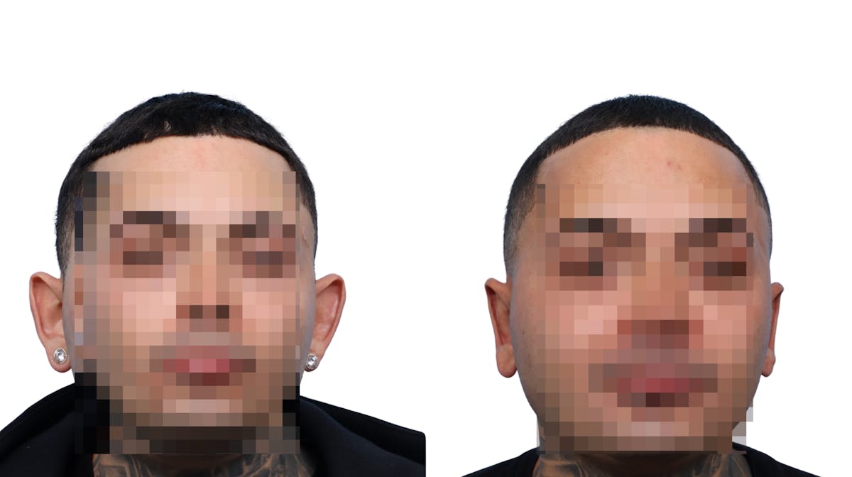 Otoplasty (Ear Surgery) Before & After Gallery - Patient 313508 - Image 2