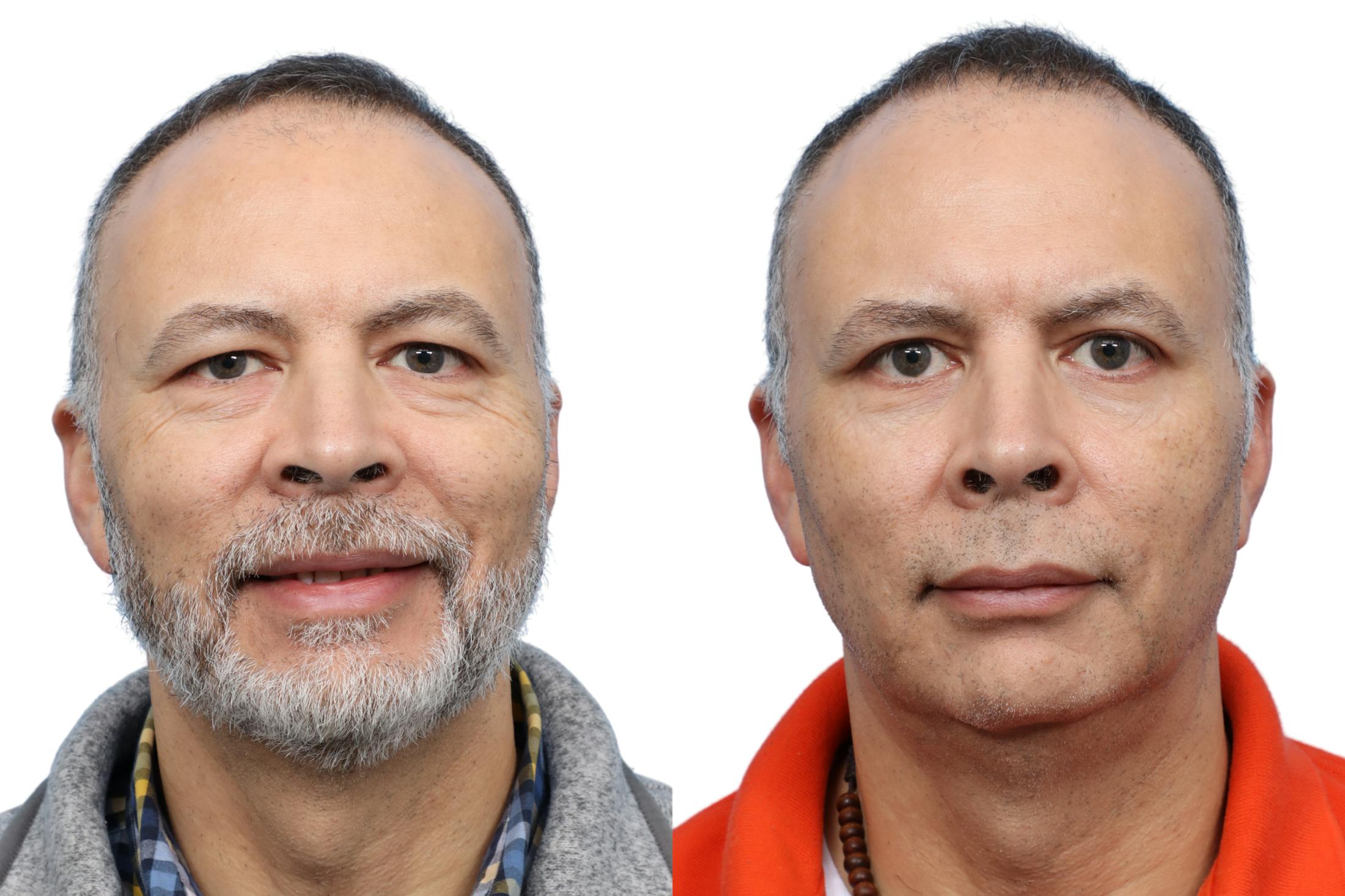 Blepharoplasty (Eyelid Surgery) Before & After Gallery - Patient 286620 - Image 1