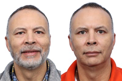 Blepharoplasty (Eyelid Surgery) Before & After Gallery - Patient 286620 - Image 1