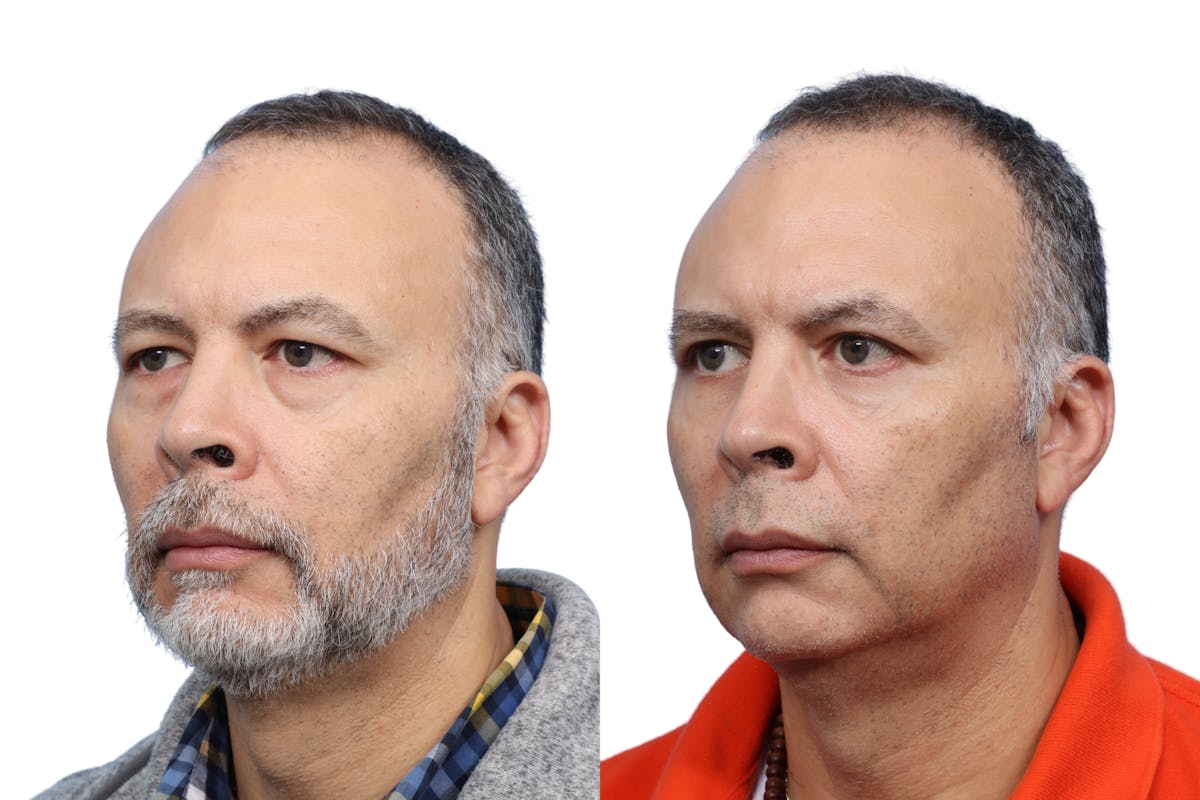 Blepharoplasty (Eyelid Surgery) Before & After Gallery - Patient 286620 - Image 2