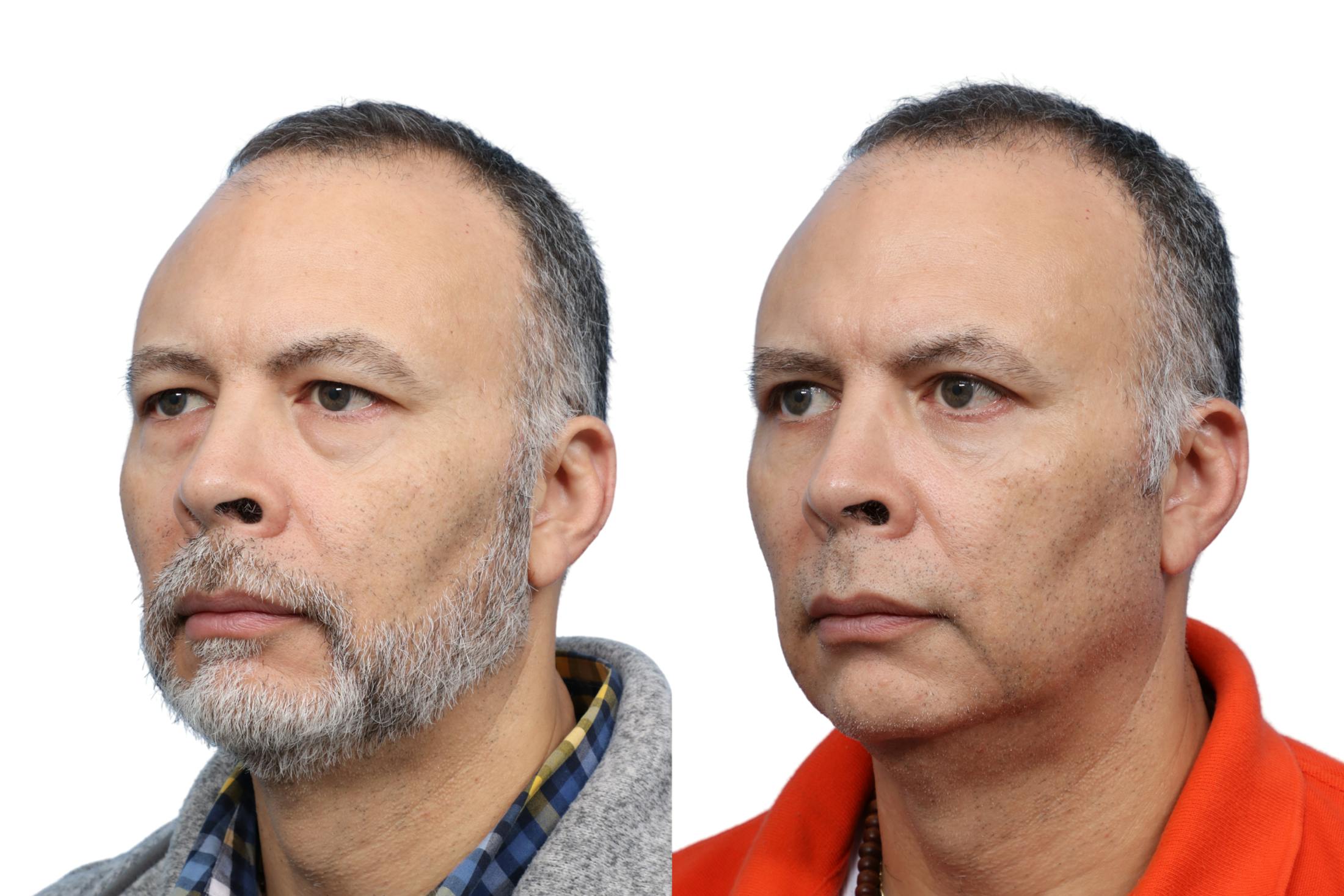 Blepharoplasty (Eyelid Surgery) Before & After Gallery - Patient 286620 - Image 2