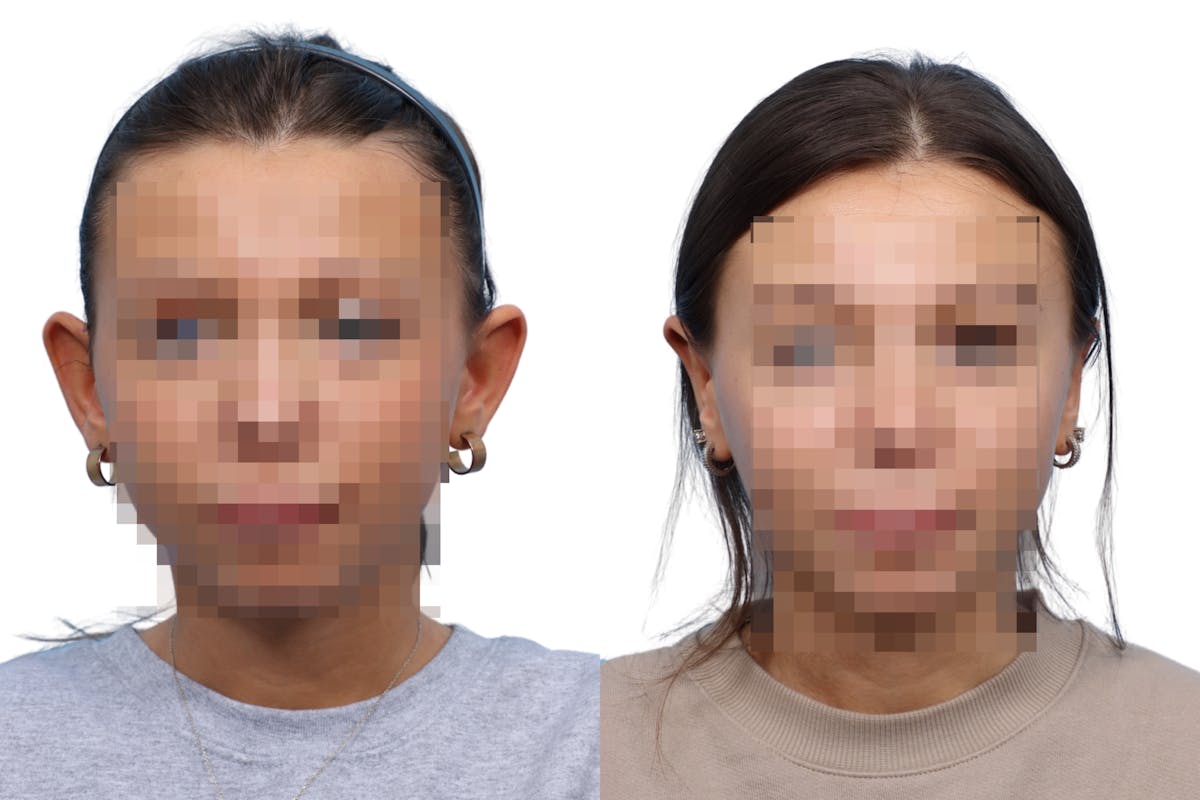 Otoplasty (Ear Surgery) Before & After Gallery - Patient 357160 - Image 1