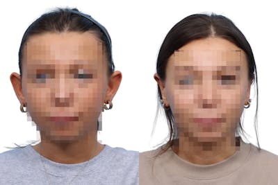 Otoplasty (Ear Surgery) Before & After Gallery - Patient 357160 - Image 1
