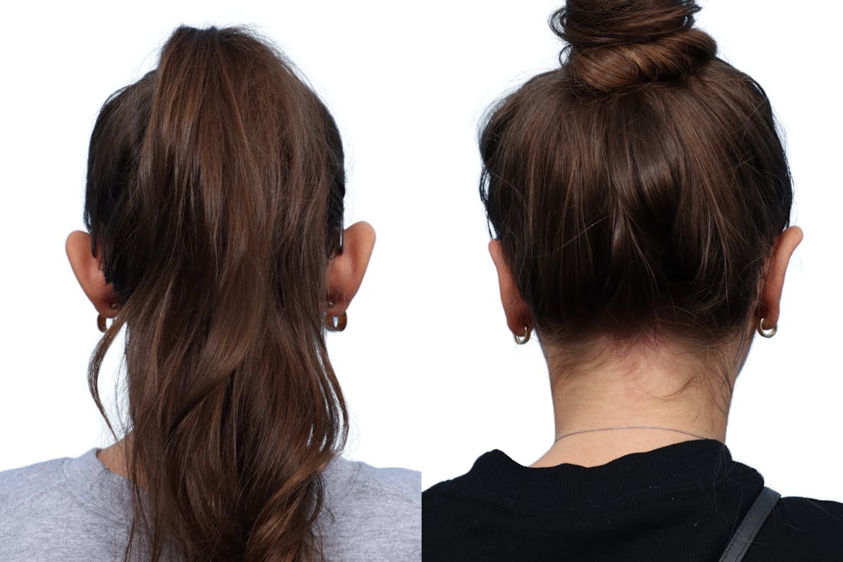 Otoplasty (Ear Surgery) Before & After Gallery - Patient 357160 - Image 2