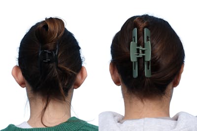 Otoplasty (Ear Surgery) Before & After Gallery - Patient 245000 - Image 1