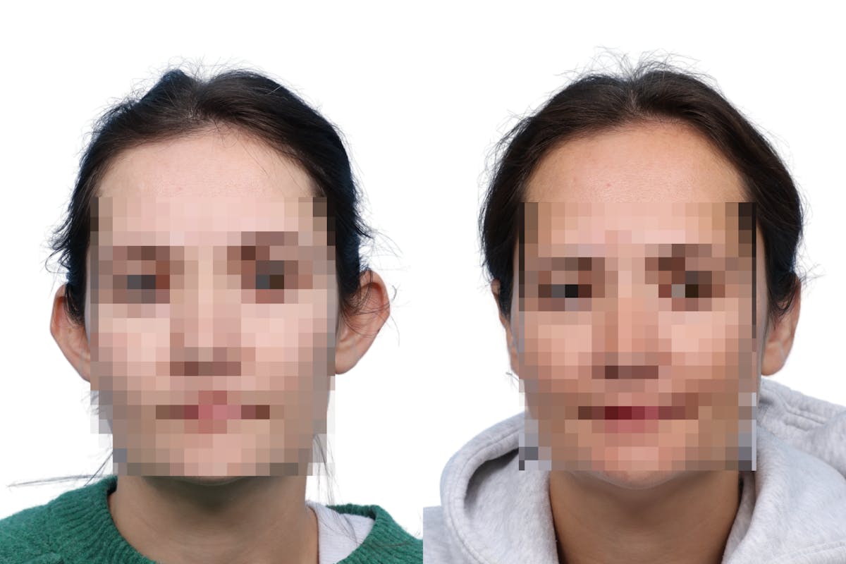 Otoplasty (Ear Surgery) Before & After Gallery - Patient 245000 - Image 2