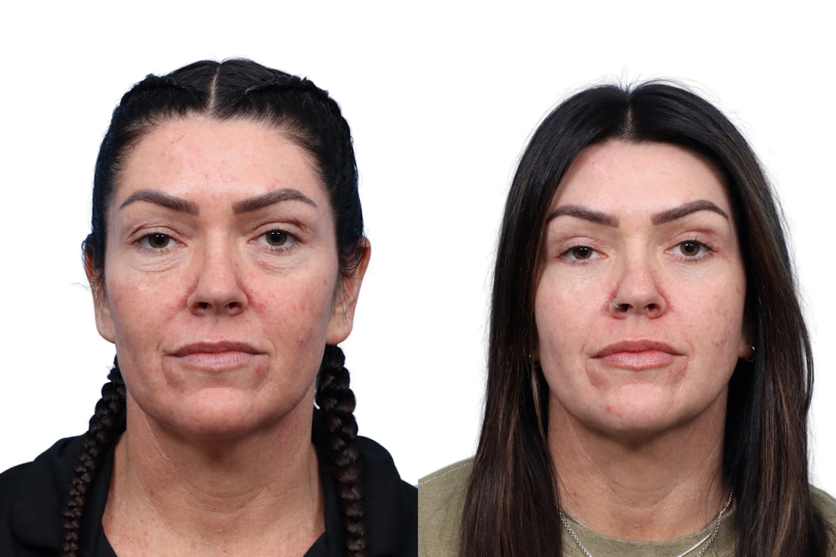 CO2 Laser Before & After Gallery - Patient 147549 - Image 1