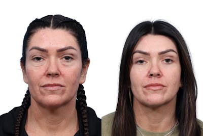 Blepharoplasty (Eyelid Surgery) Before & After Gallery - Patient 295877 - Image 1