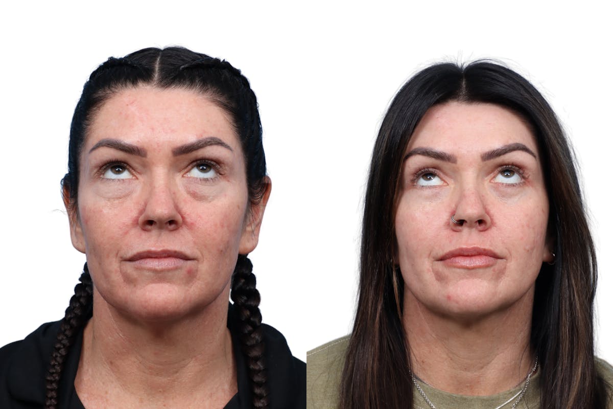 CO2 Laser Before & After Gallery - Patient 147549 - Image 2