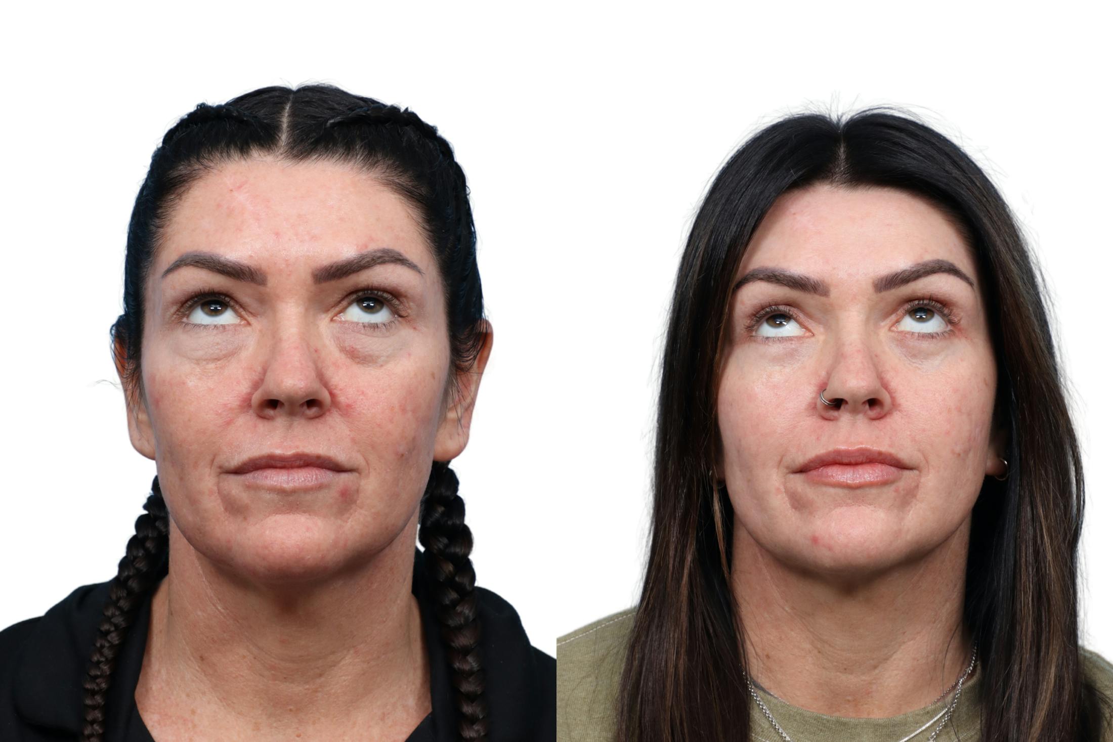 CO2 Laser Before & After Gallery - Patient 147549 - Image 2