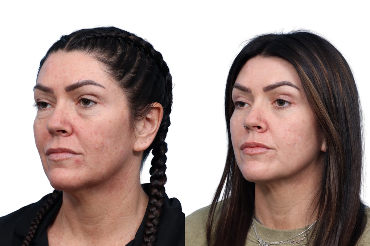 CO2 Laser Before & After Gallery - Patient 147549 - Image 3