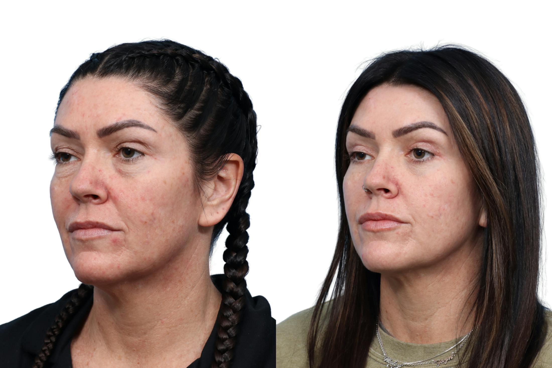 CO2 Laser Before & After Gallery - Patient 147549 - Image 3