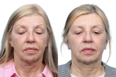 Blepharoplasty (Eyelid Surgery) Before & After Gallery - Patient 202566 - Image 1
