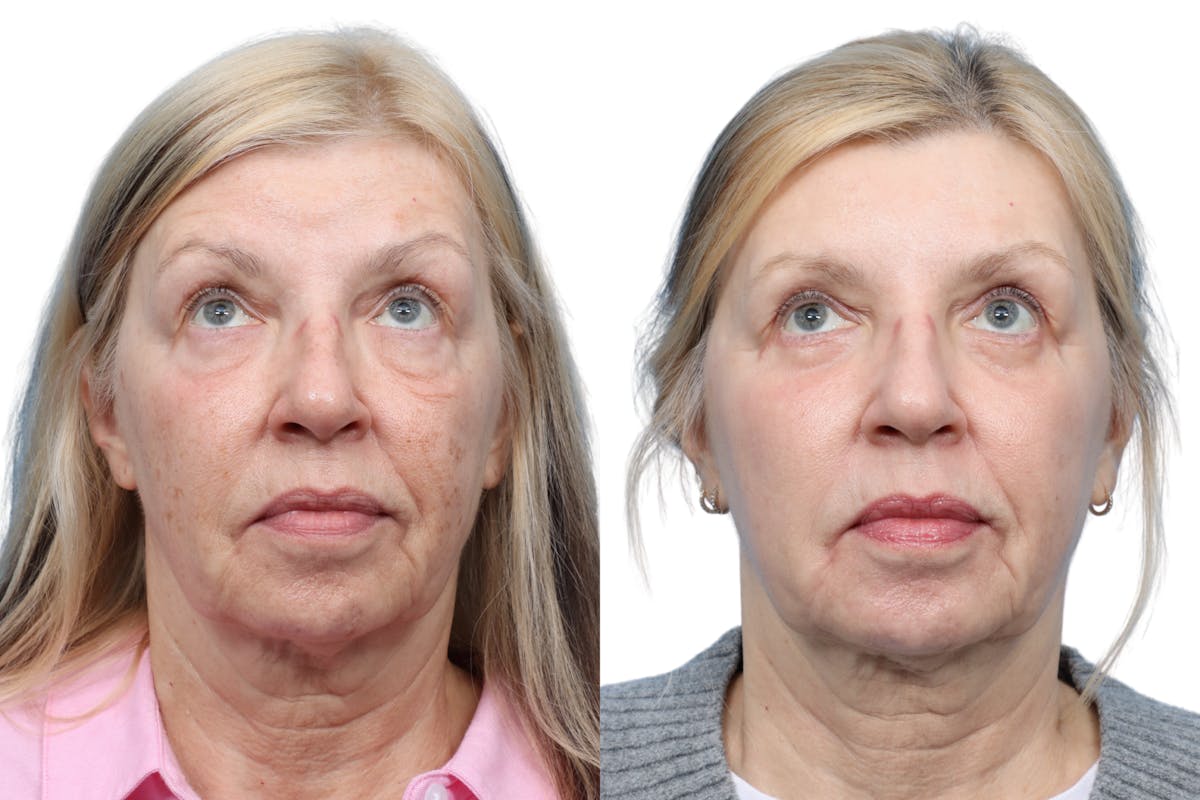 Blepharoplasty (Eyelid Surgery) Before & After Gallery - Patient 202566 - Image 2