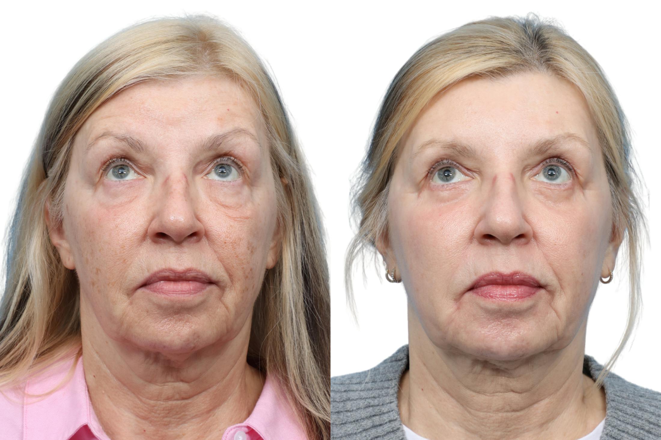 Blepharoplasty (Eyelid Surgery) Before & After Gallery - Patient 202566 - Image 2