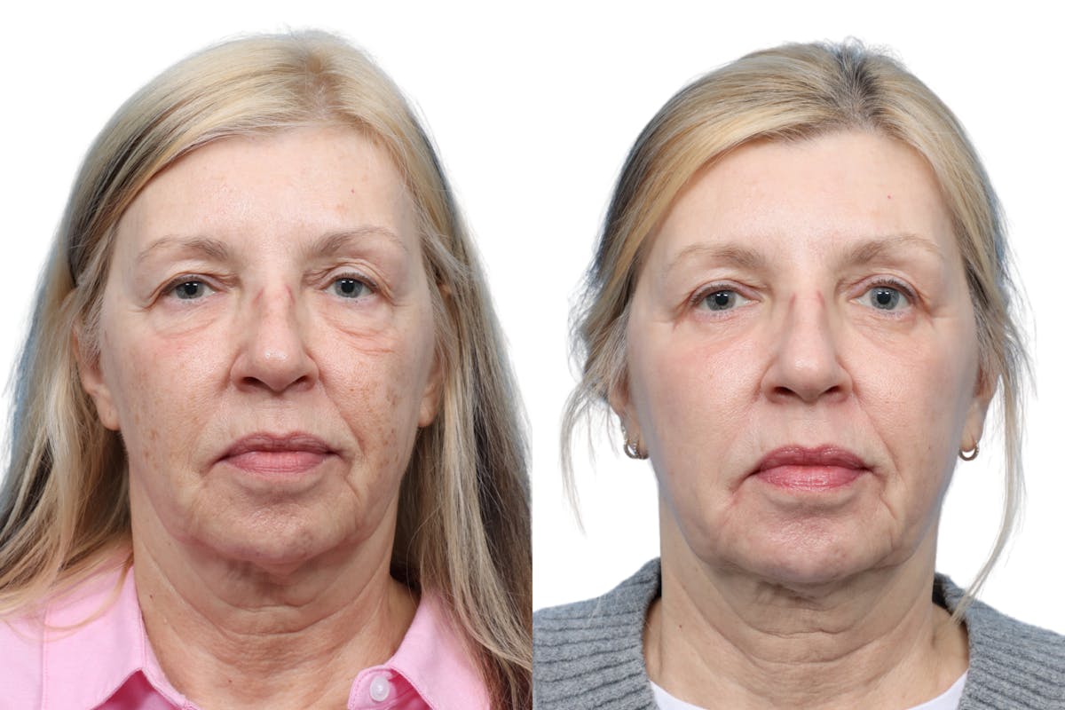 Blepharoplasty (Eyelid Surgery) Before & After Gallery - Patient 202566 - Image 3
