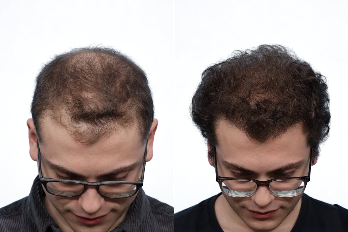 FUE Hair Transplant Before & After Gallery - Patient 353054 - Image 2