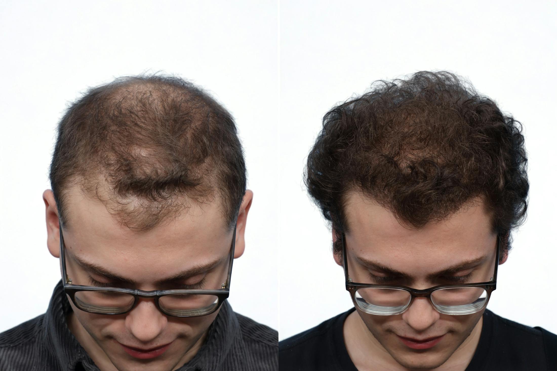 FUE Hair Transplant Before & After Gallery - Patient 353054 - Image 2