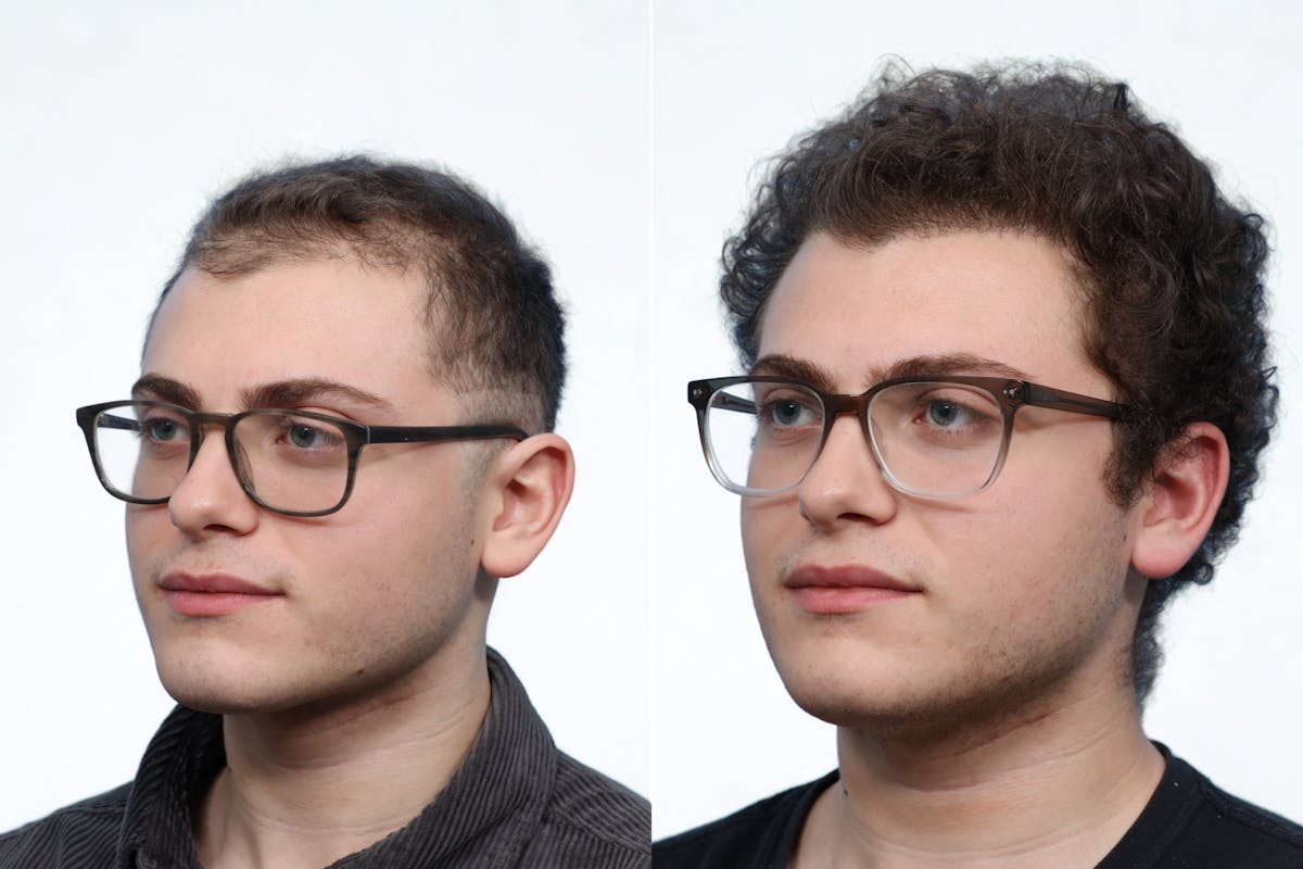 FUE Hair Transplant Before & After Gallery - Patient 353054 - Image 3