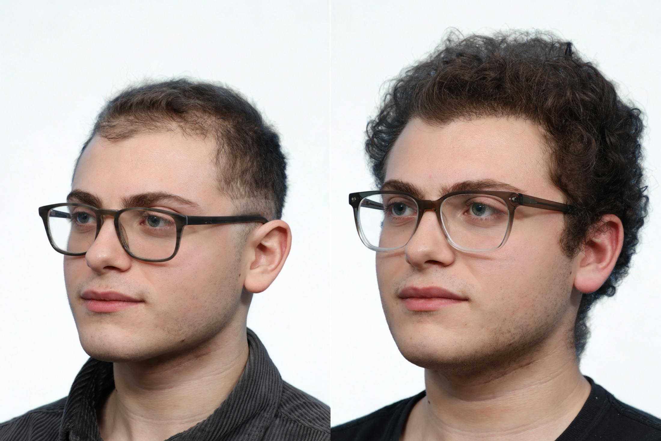 FUE Hair Transplant Before & After Gallery - Patient 353054 - Image 3