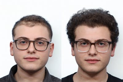 FUE Hair Transplant Before & After Gallery - Patient 353054 - Image 1