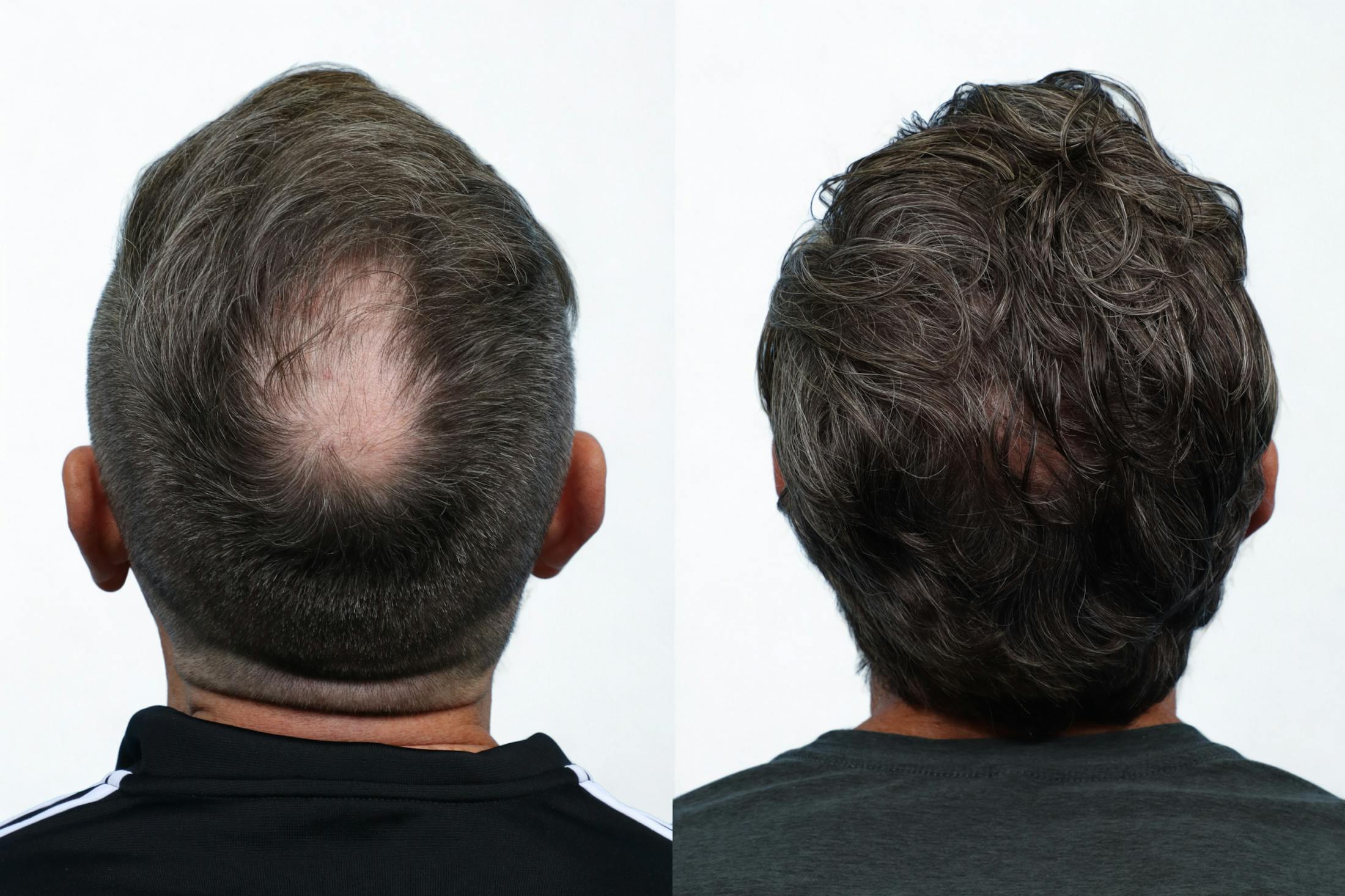 FUE Hair Transplant Before & After Gallery - Patient 565134 - Image 2