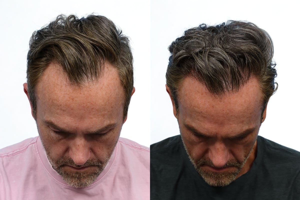 FUE Hair Transplant Before & After Gallery - Patient 565134 - Image 1