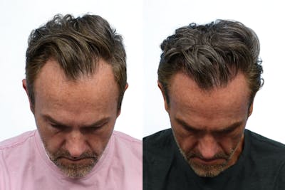 FUE Hair Transplant Before & After Gallery - Patient 565134 - Image 1