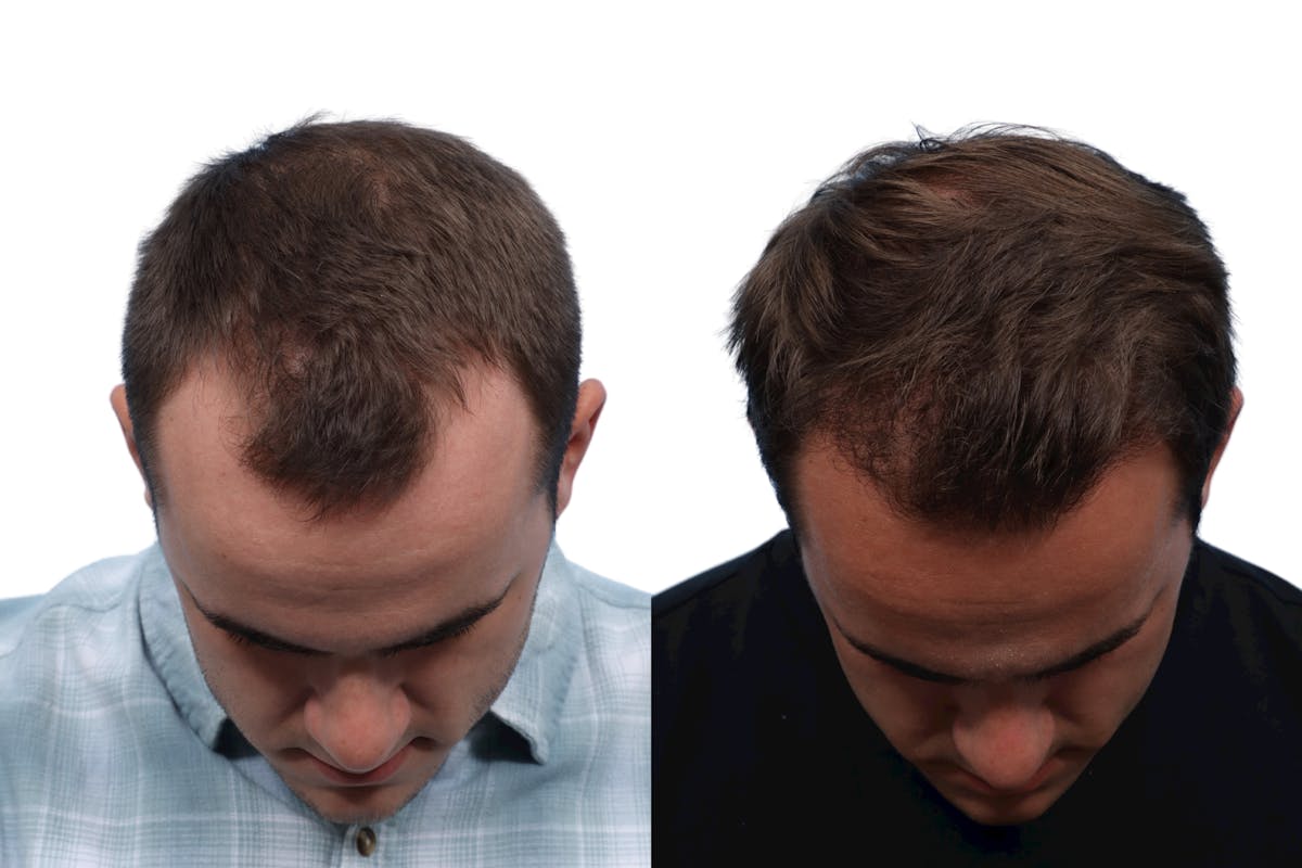 FUE Hair Transplant Before & After Gallery - Patient 206544 - Image 3