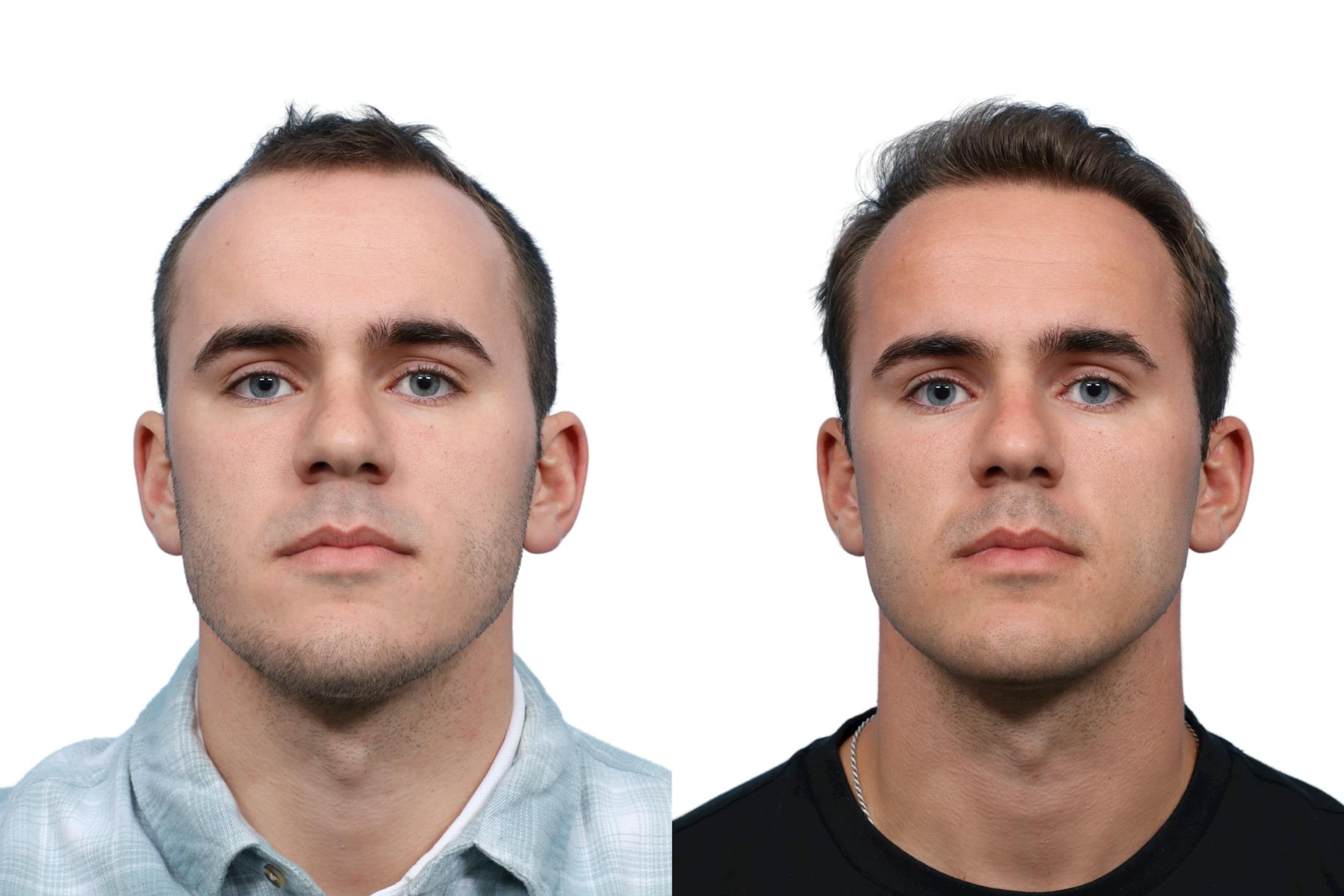 FUE Hair Transplant Before & After Gallery - Patient 206544 - Image 1