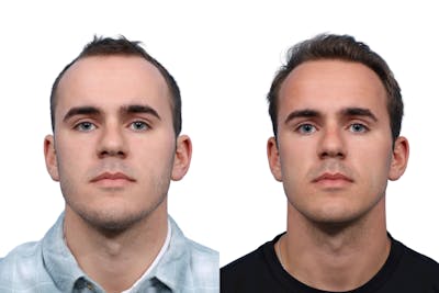 FUE Hair Transplant Before & After Gallery - Patient 206544 - Image 1