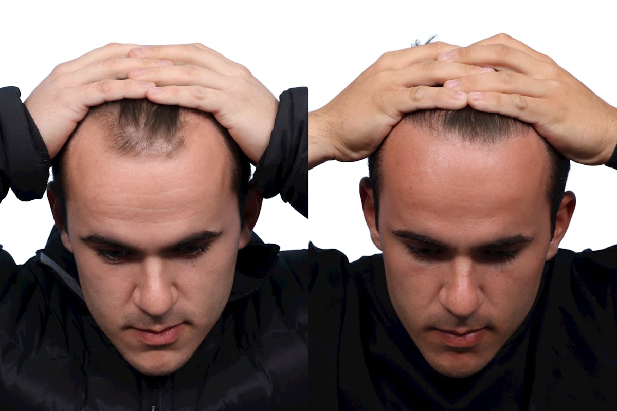 FUE Hair Transplant Before & After Gallery - Patient 206544 - Image 2