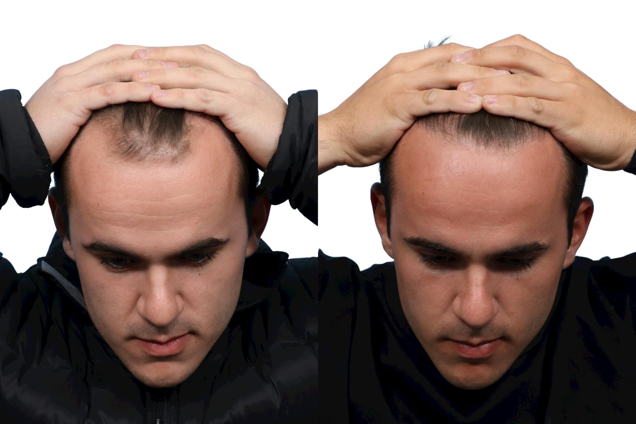 FUE Hair Transplant Before & After Gallery - Patient 206544 - Image 2