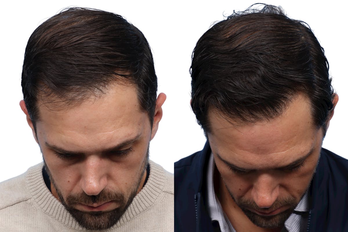 FUE Hair Transplant Before & After Gallery - Patient 244076 - Image 2