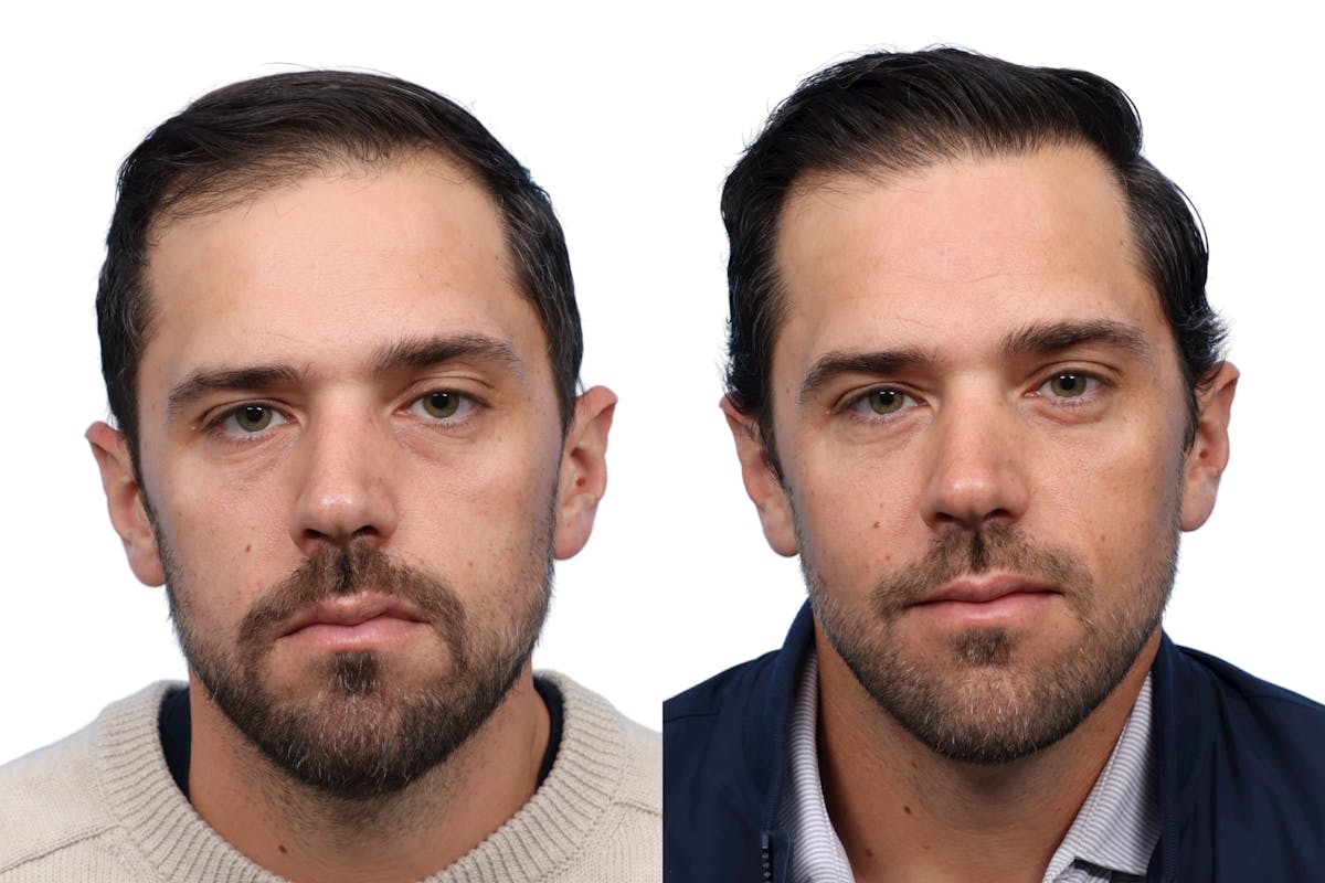 FUE Hair Transplant Before & After Gallery - Patient 244076 - Image 1