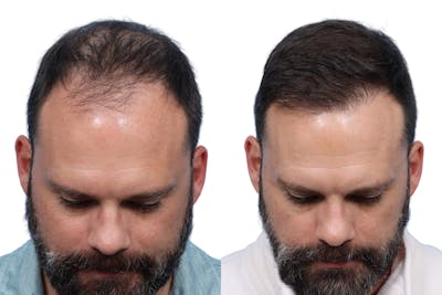 FUE Hair Transplant Before & After Gallery - Patient 373931 - Image 1