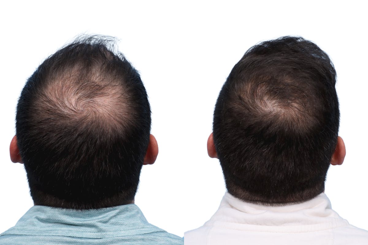 FUE Hair Transplant Before & After Gallery - Patient 373931 - Image 2