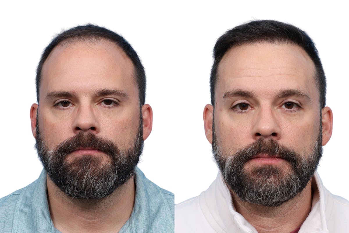 FUE Hair Transplant Before & After Gallery - Patient 373931 - Image 3