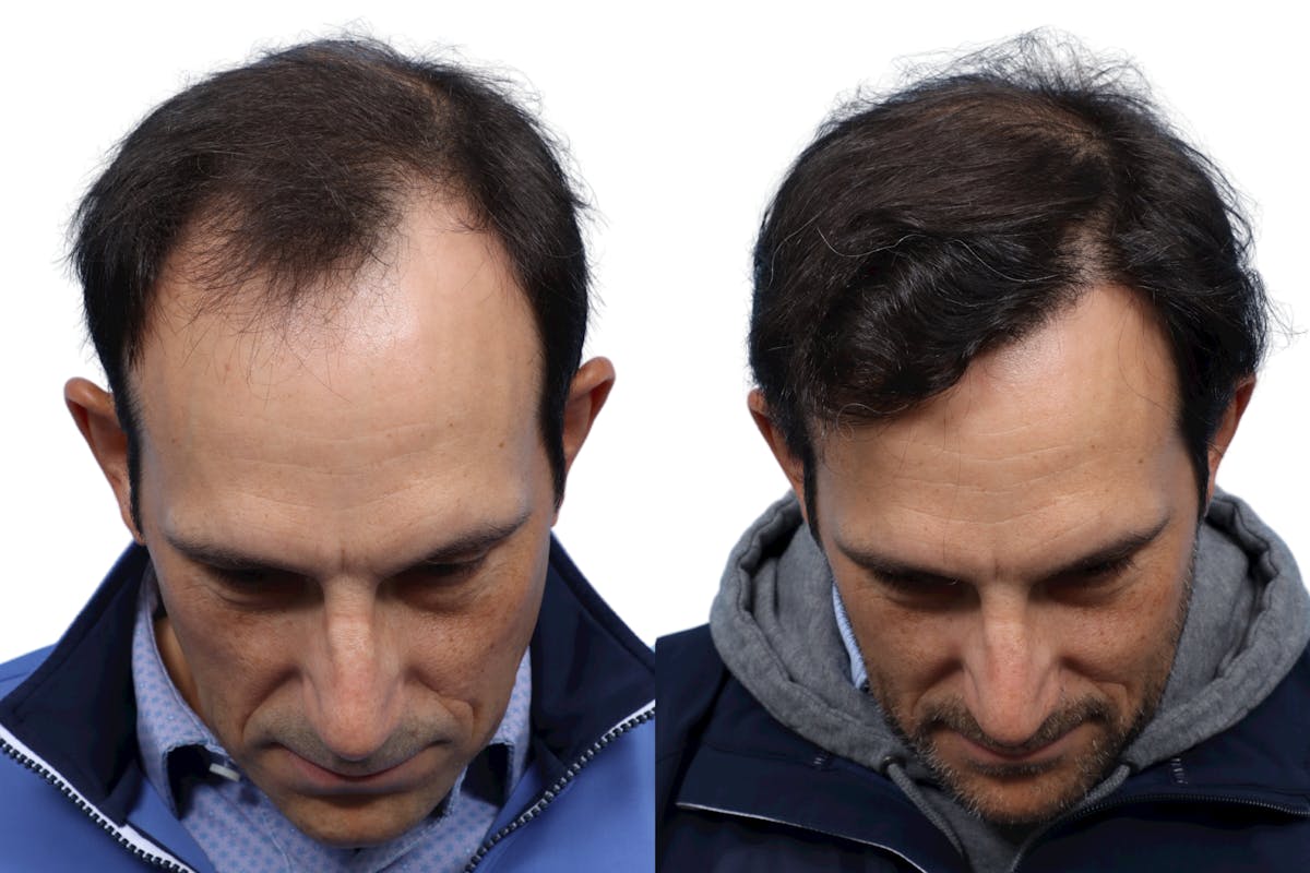 FUE Hair Transplant Before & After Gallery - Patient 961326 - Image 1