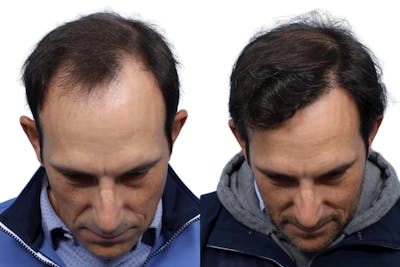 FUE Hair Transplant Before & After Gallery - Patient 961326 - Image 1