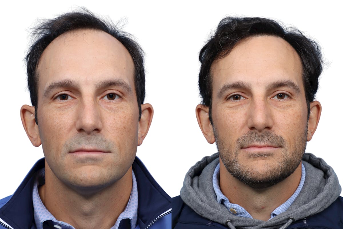 FUE Hair Transplant Before & After Gallery - Patient 961326 - Image 2