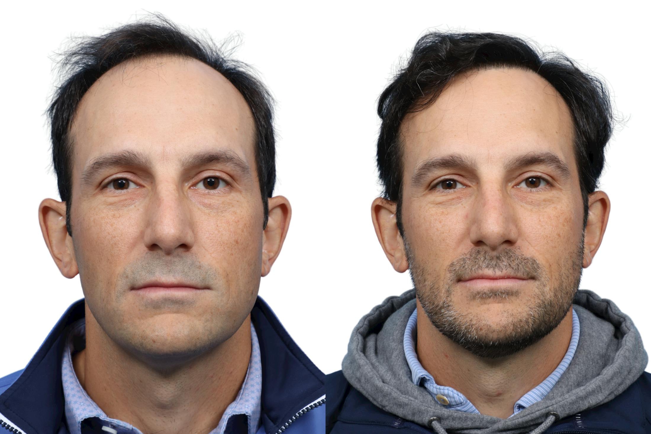 FUE Hair Transplant Before & After Gallery - Patient 961326 - Image 2