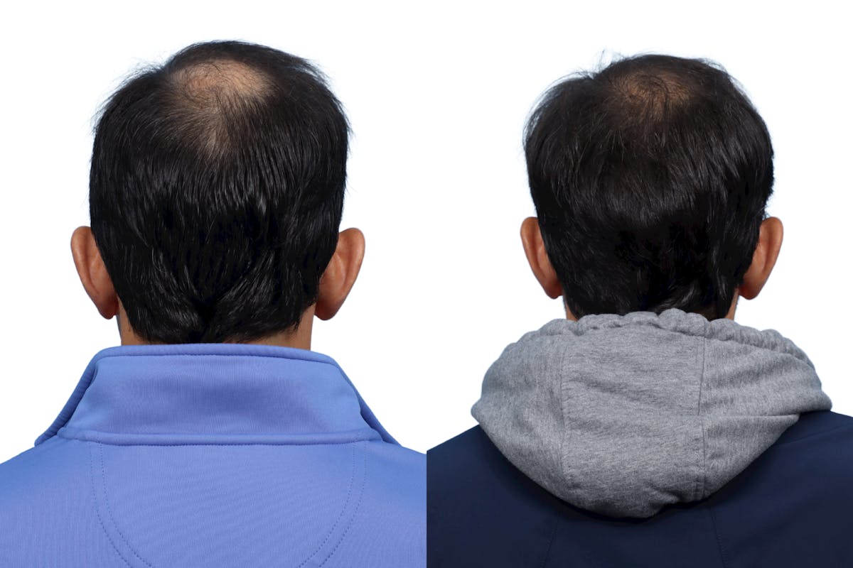 FUE Hair Transplant Before & After Gallery - Patient 961326 - Image 3