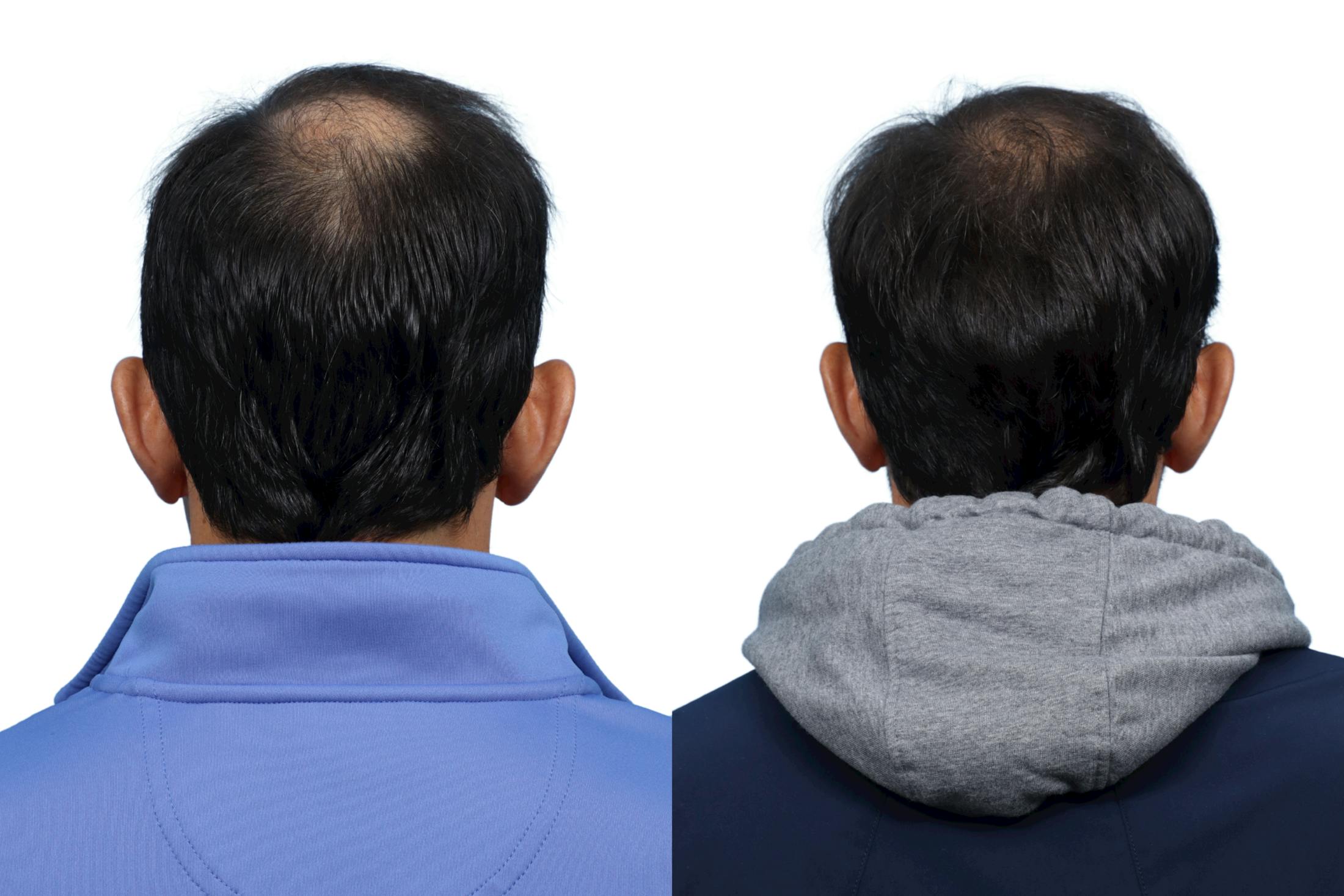 FUE Hair Transplant Before & After Gallery - Patient 961326 - Image 3