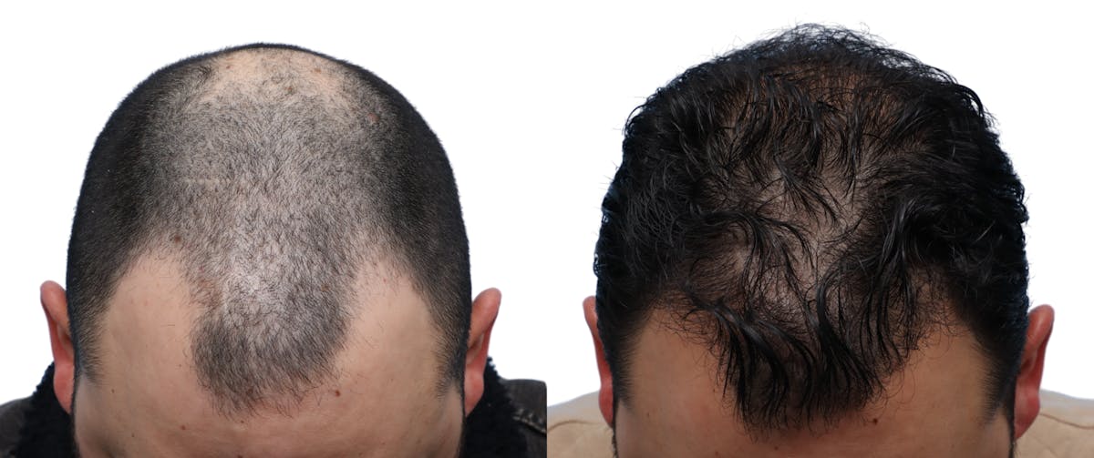 FUE Hair Transplant Before & After Gallery - Patient 111135 - Image 1
