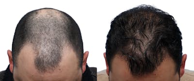 FUE Hair Transplant Before & After Gallery - Patient 111135 - Image 1
