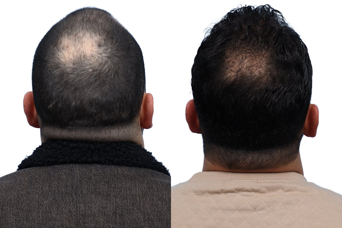 FUE Hair Transplant Before & After Gallery - Patient 111135 - Image 2