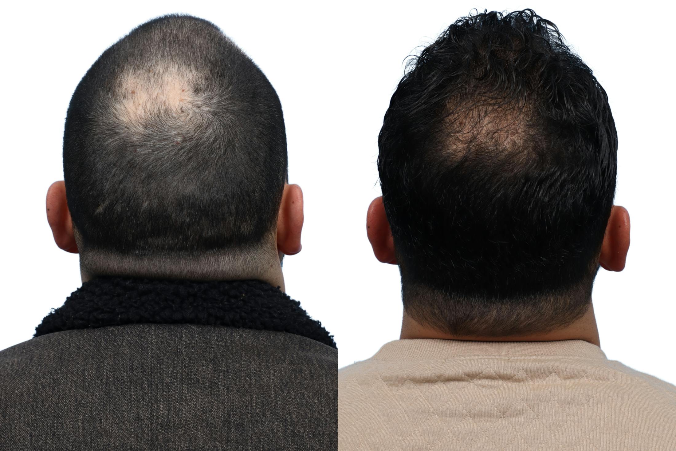 FUE Hair Transplant Before & After Gallery - Patient 111135 - Image 2