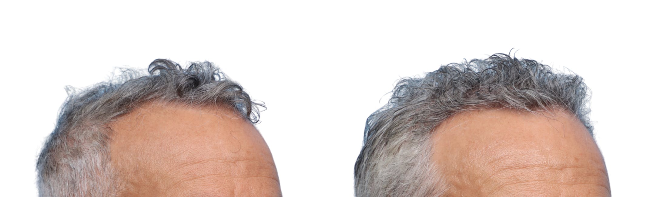FUE Hair Transplant Before & After Gallery - Patient 289627 - Image 1