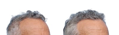 FUE Hair Transplant Before & After Gallery - Patient 289627 - Image 1